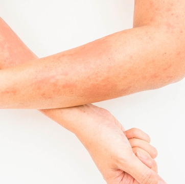 Dermatitis de contacto