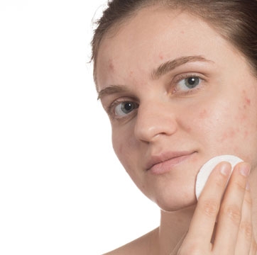 Uso de sérum en pieles con acné